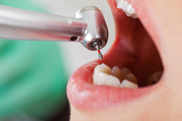 Best Emergency Root Canal Treatment in Camano, WA